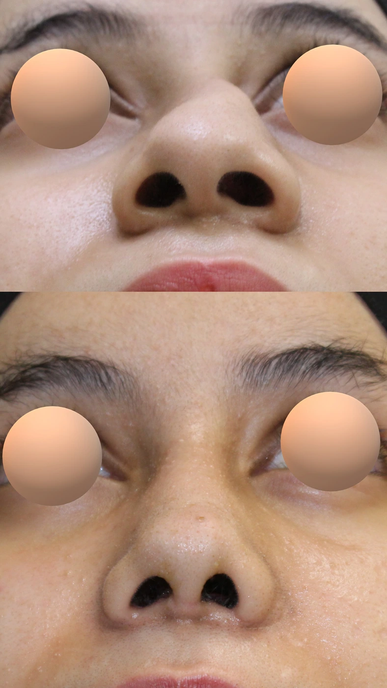 Crooked-nose rhinoplasty — Basal view