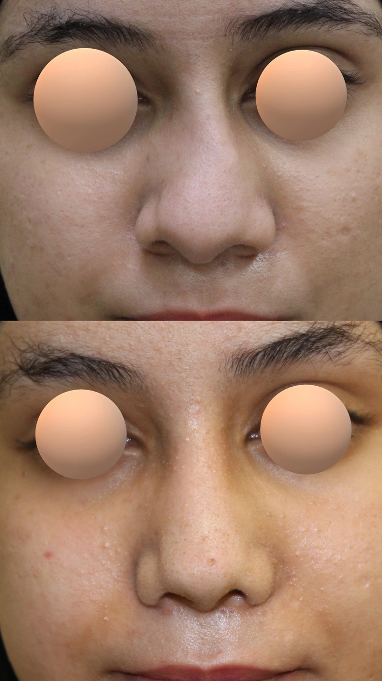 Crooked-nose rhinoplasty — Front