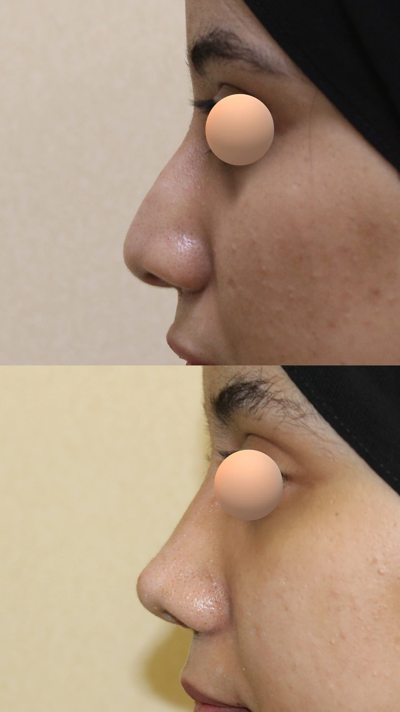 Crooked-nose rhinoplasty — Left profile
