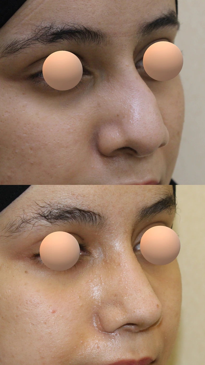 Crooked-nose rhinoplasty — Right oblique