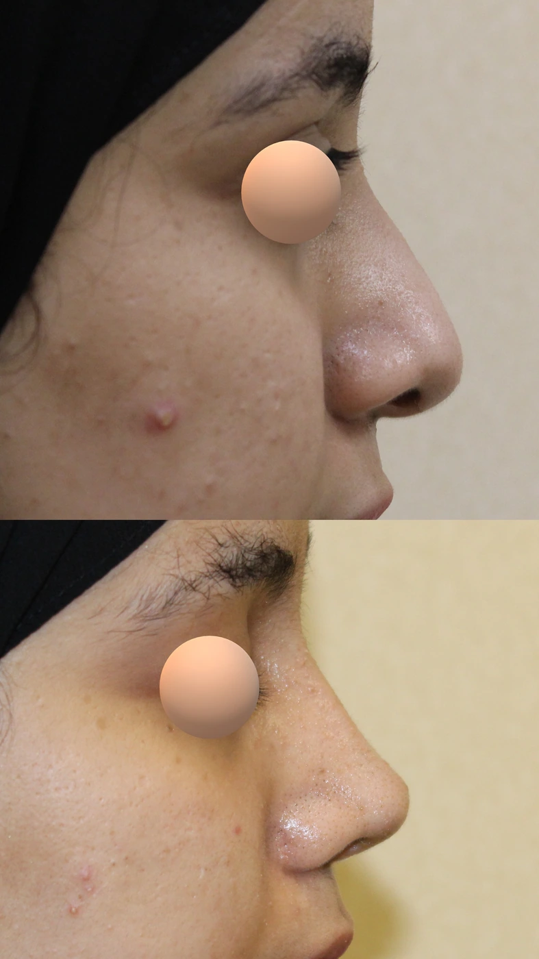 Crooked-nose rhinoplasty — Right profile