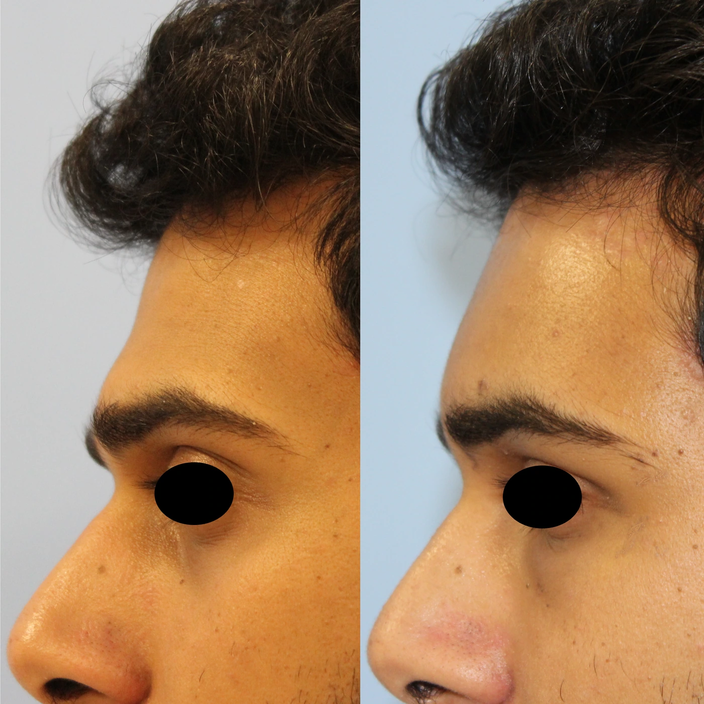 Facial fat grafting — Left profile