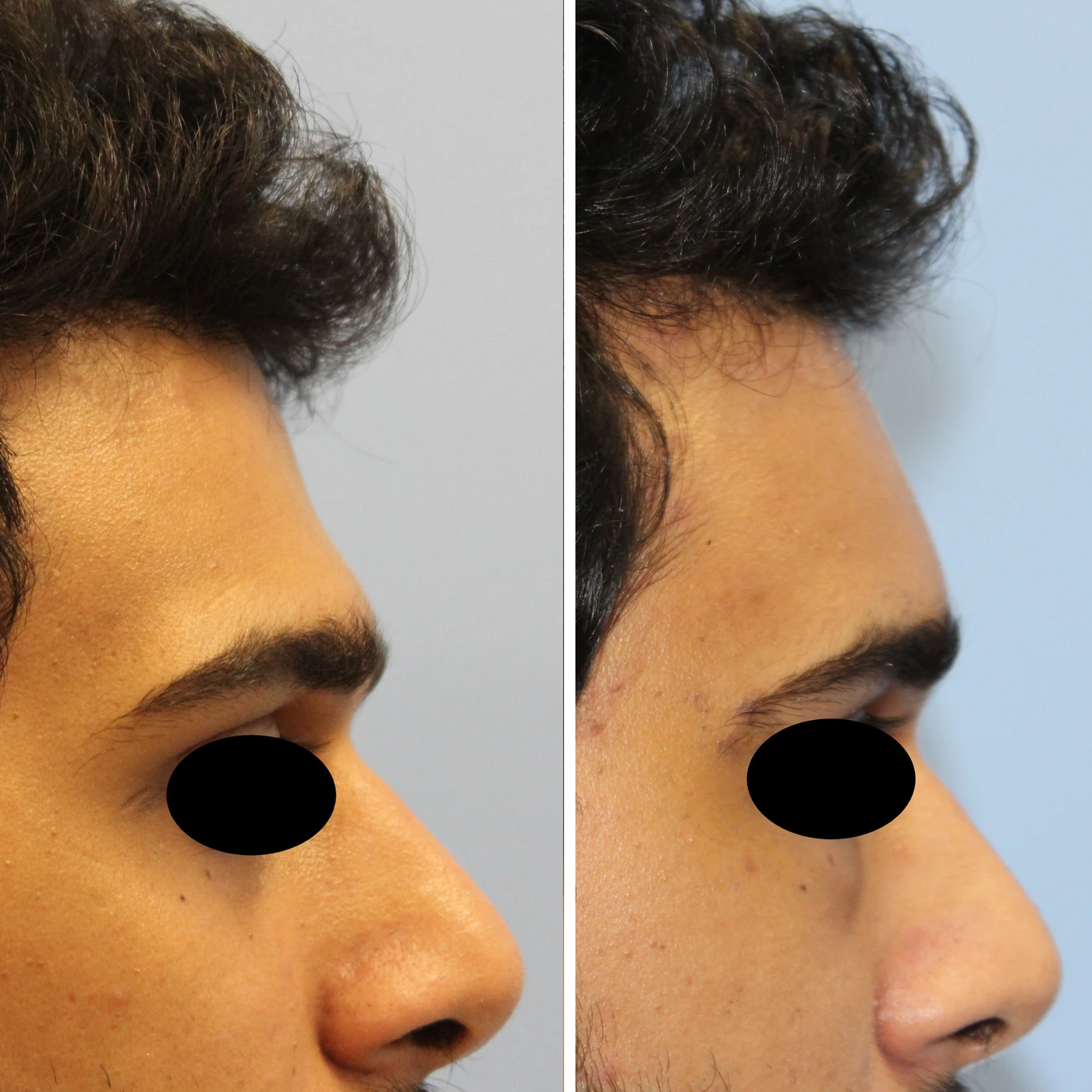 Facial fat grafting — Right profile