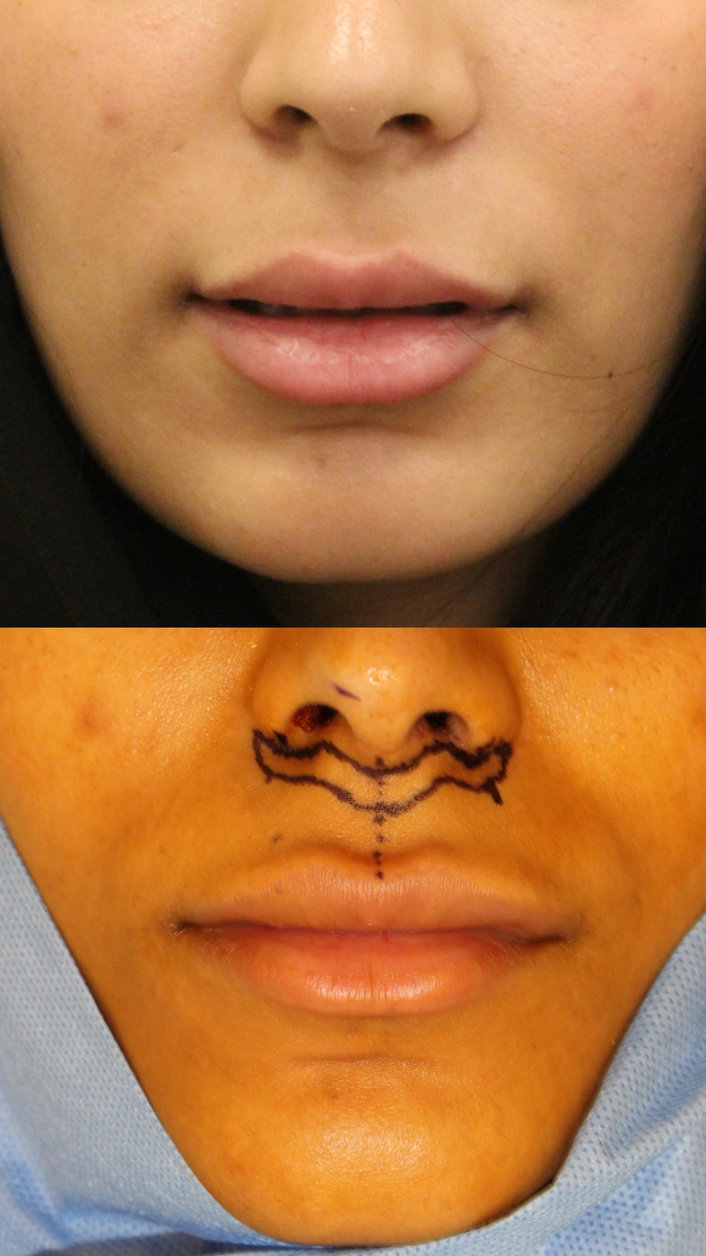 Upper lip lift — Surgical planning