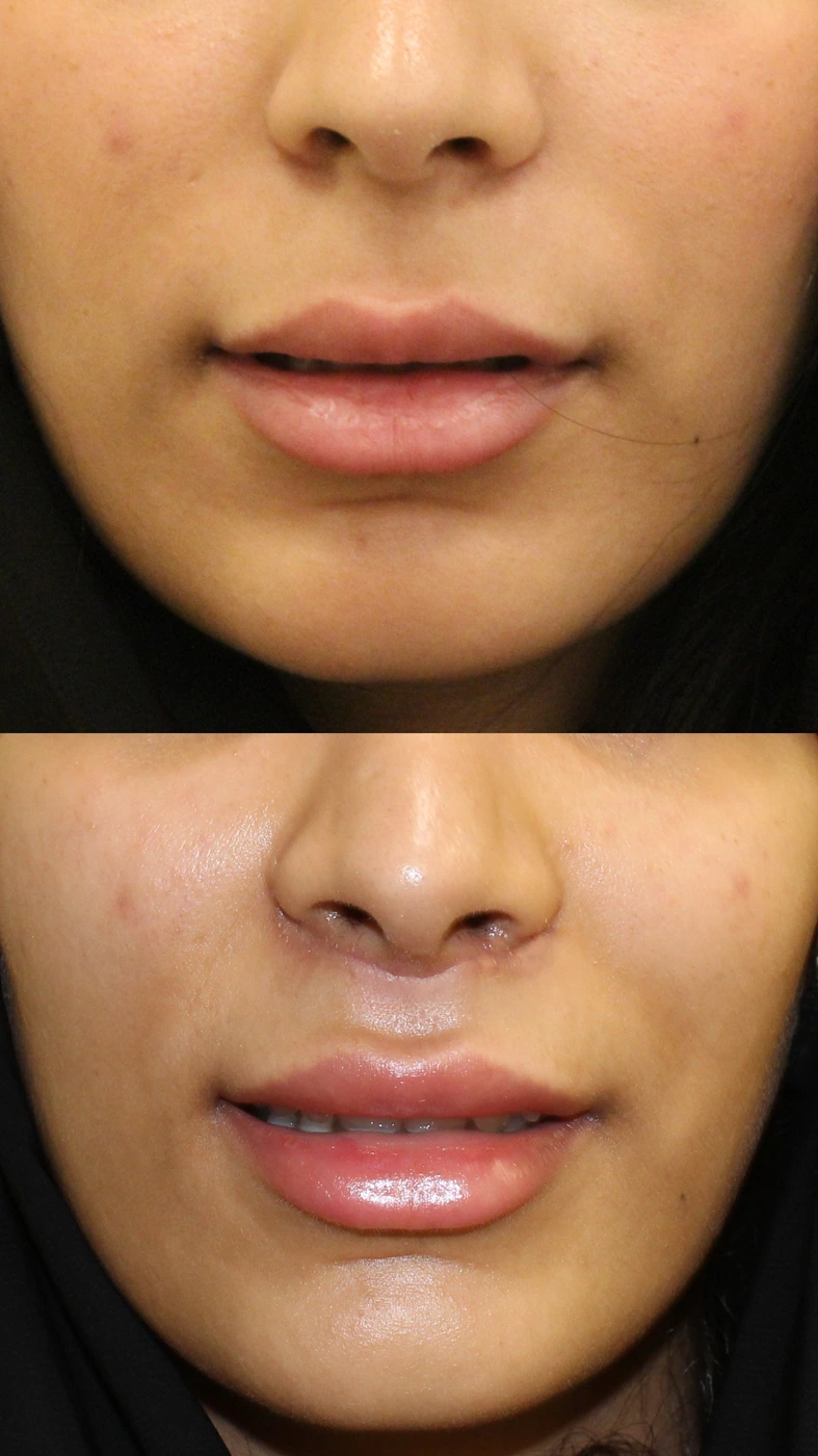 Upper lip lift — Front follow-up
