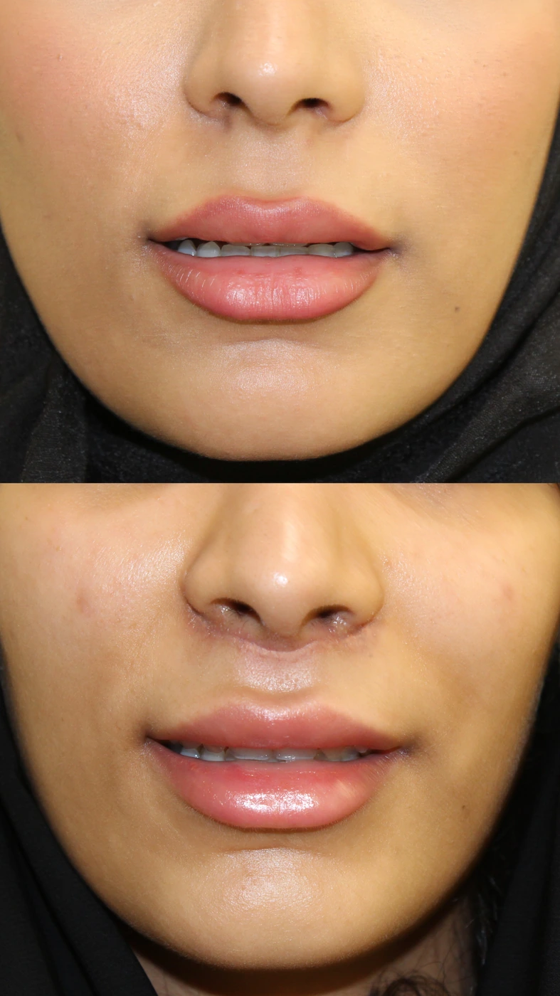 Upper lip lift — Lip detail