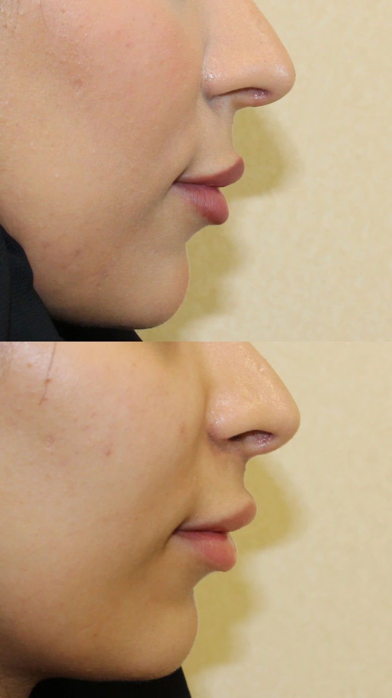 Upper lip lift — Left profile