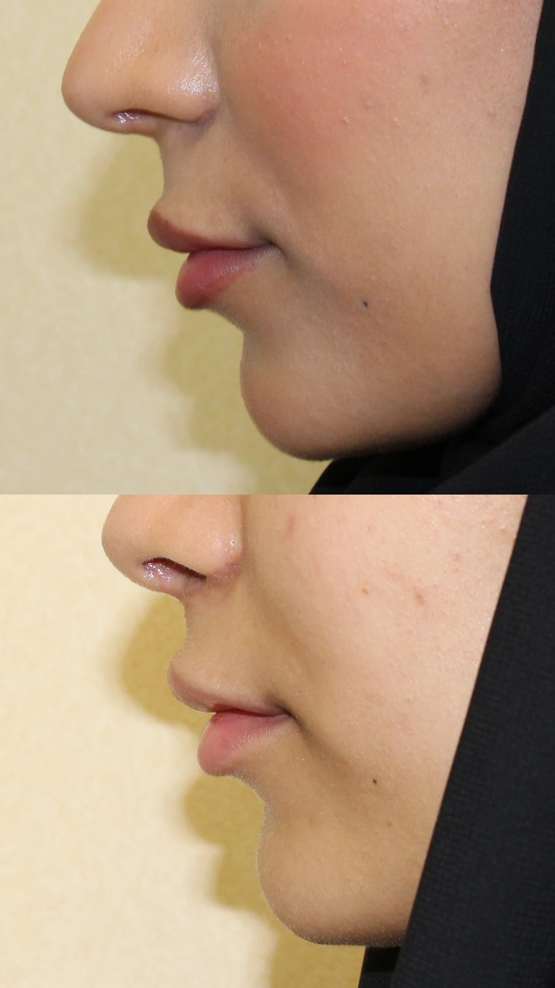 Upper lip lift — Right profile