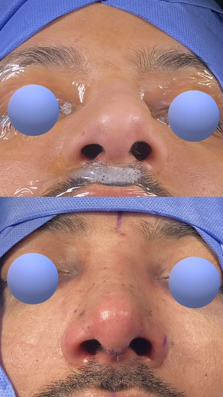 Male rhinoplasty — Basal view