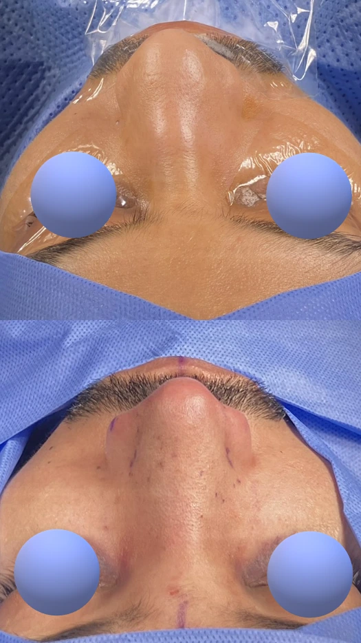 Male rhinoplasty — Top view
