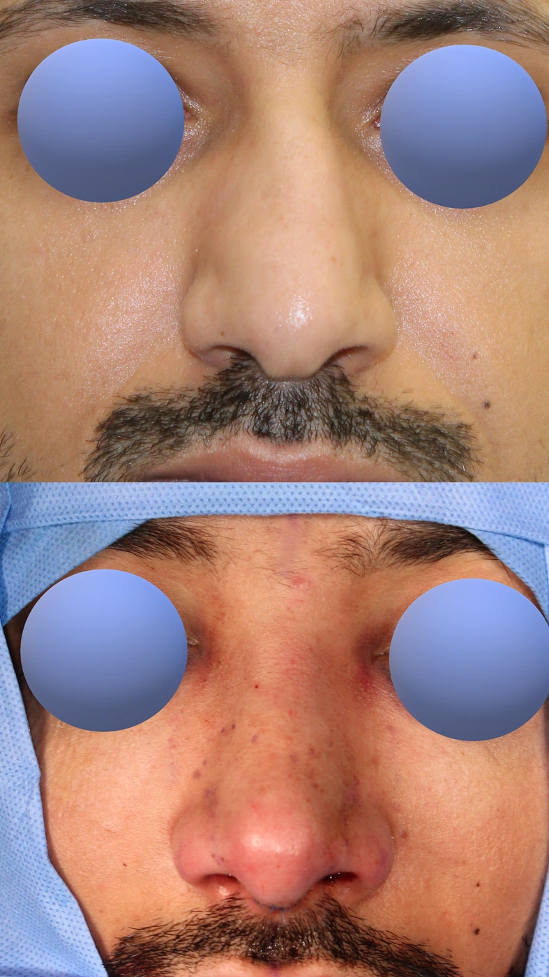 Male rhinoplasty — Front