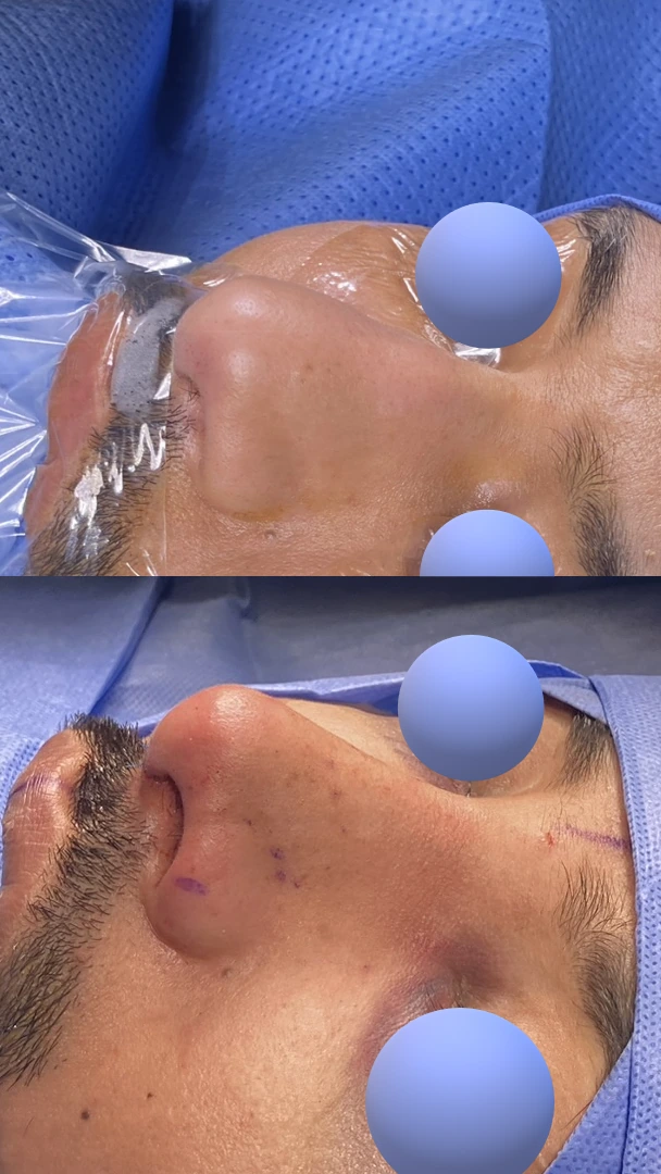 Male rhinoplasty — Left oblique