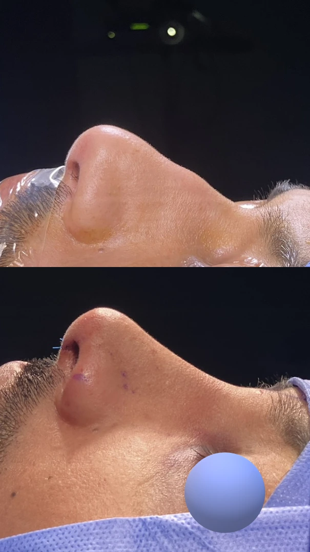 Male rhinoplasty — Left profile