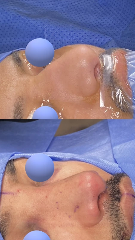 Male rhinoplasty — Right oblique