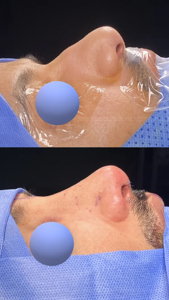 Male rhinoplasty — Right profile