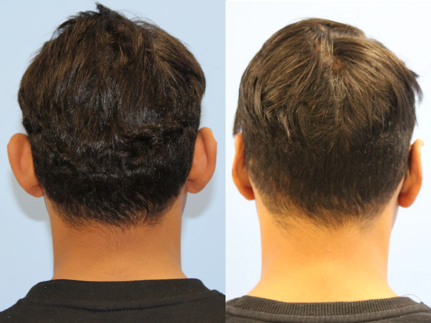 Otoplasty — Rear view