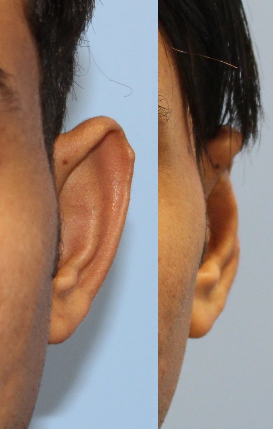 Otoplasty — Left ear