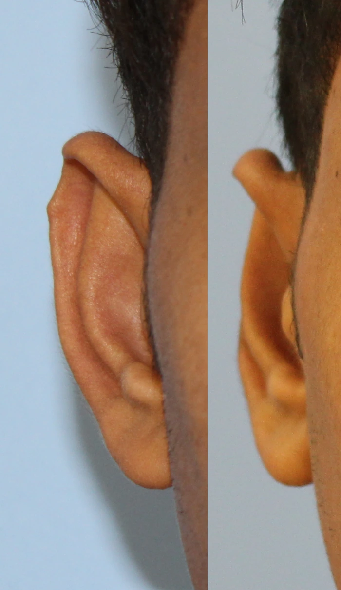 Otoplasty — Right ear
