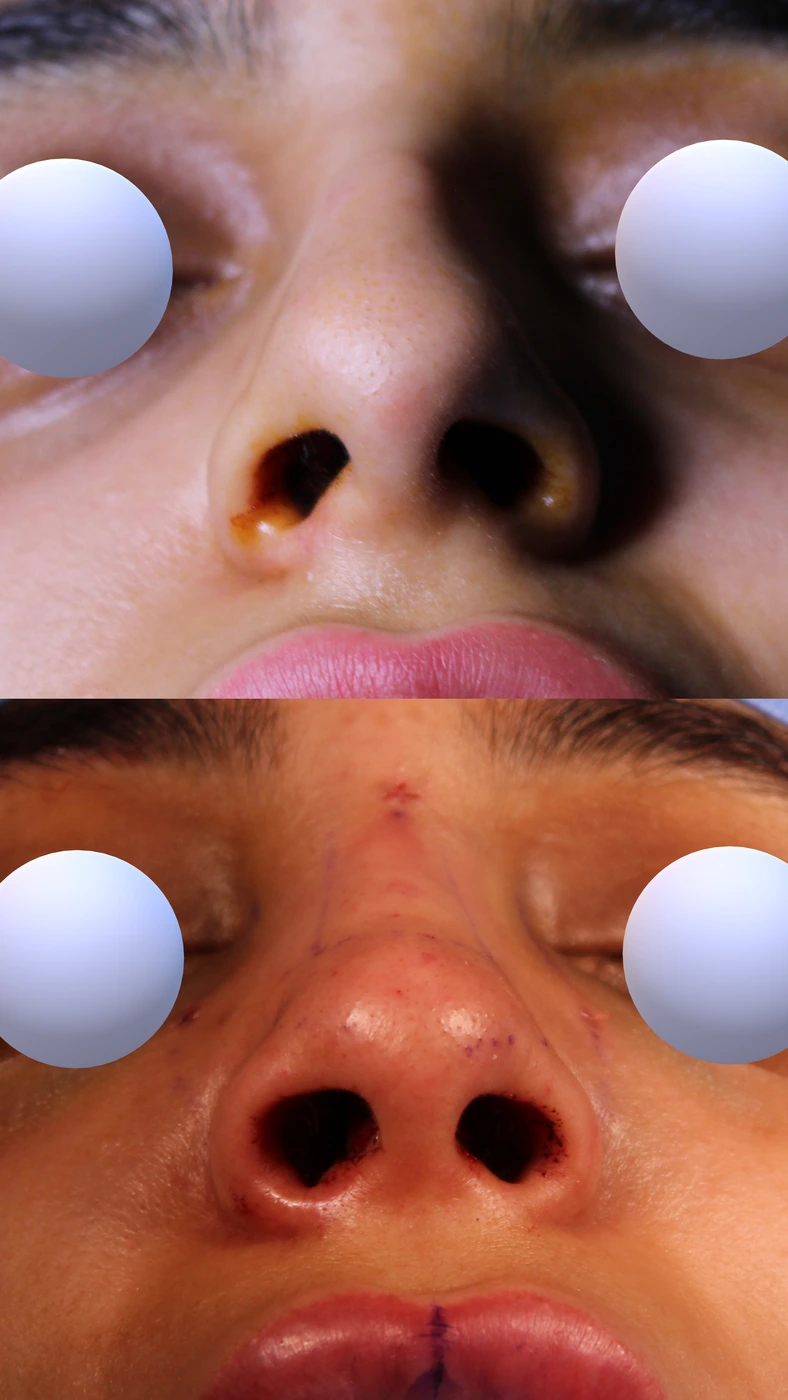 Closed preservation rhinoplasty — Basal view