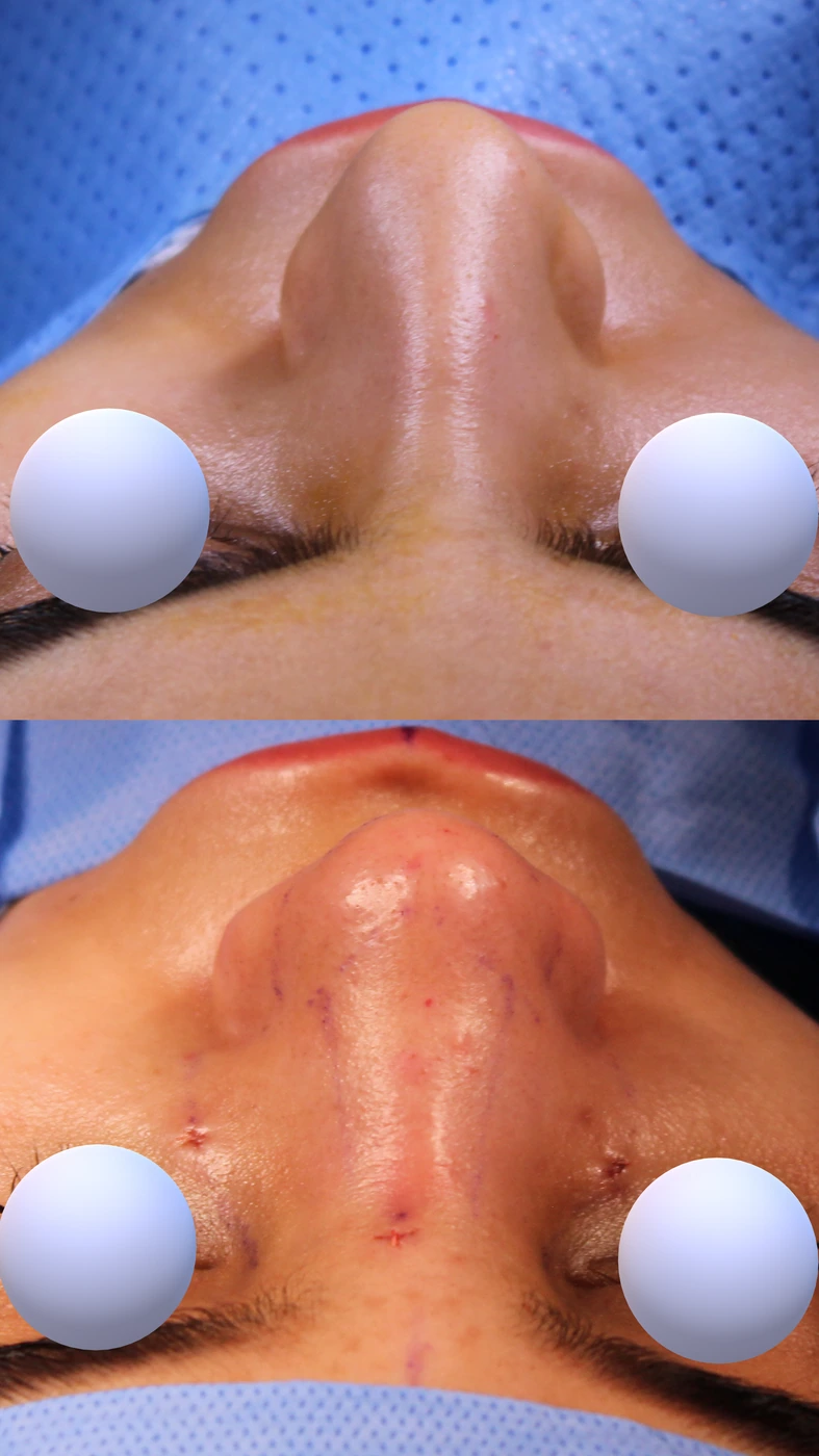 Closed preservation rhinoplasty — Top view