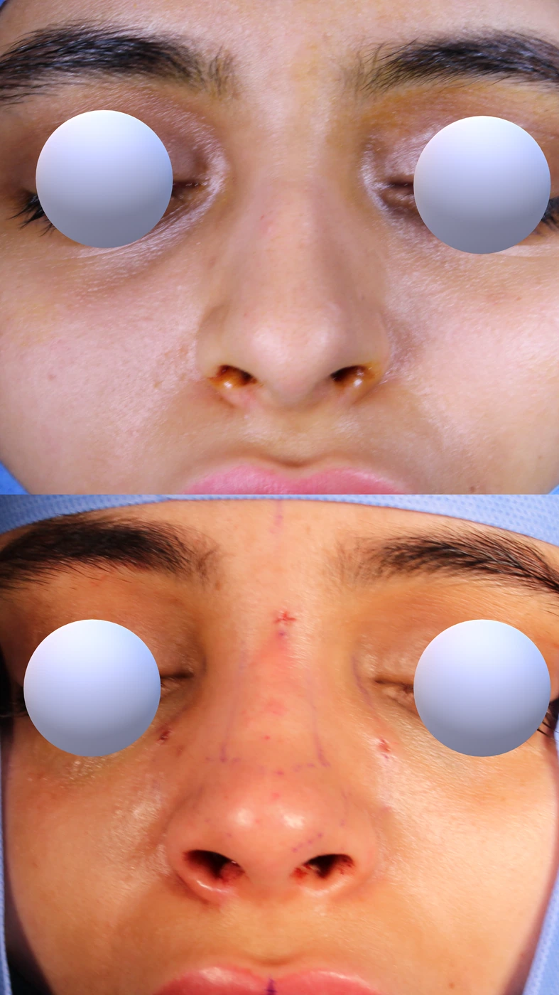 Closed preservation rhinoplasty — Front