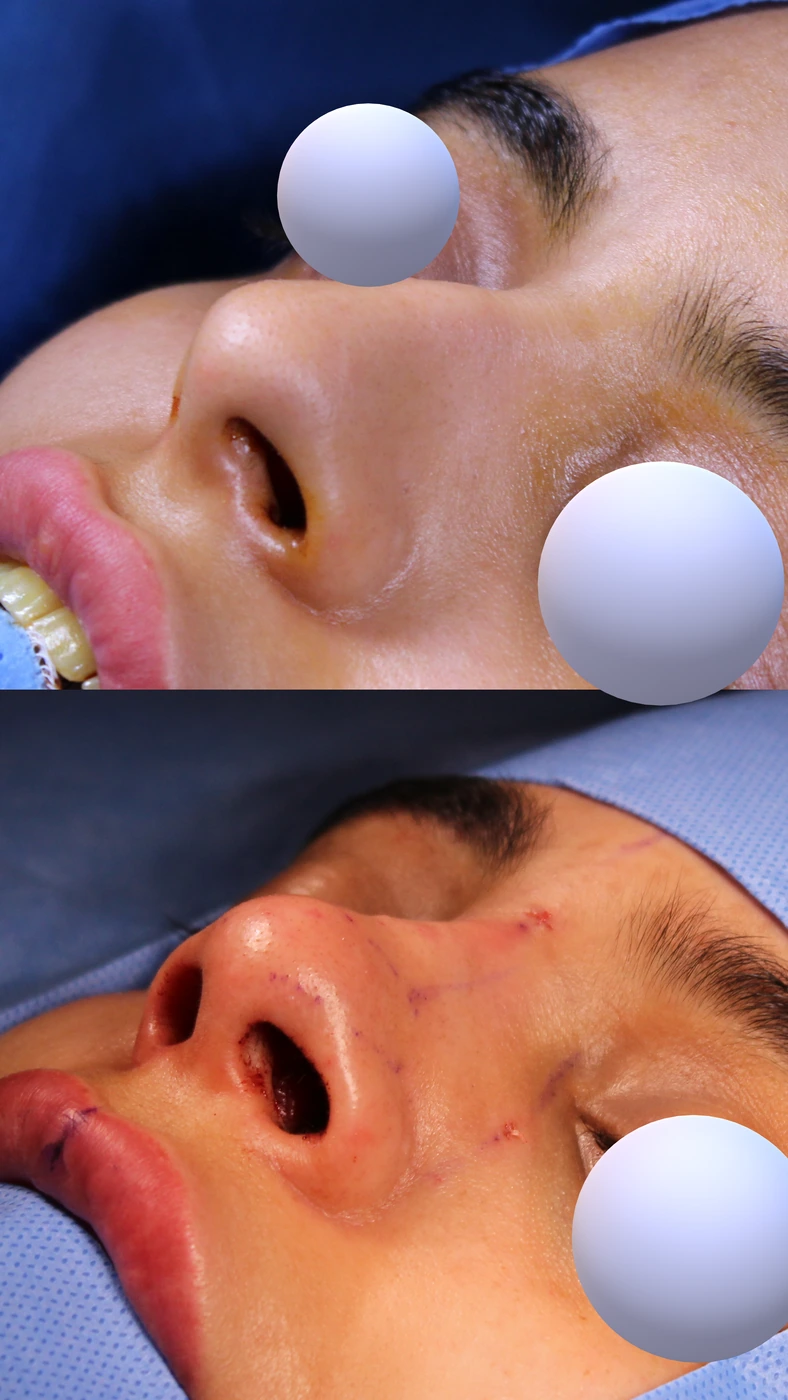Closed preservation rhinoplasty — Left lower oblique