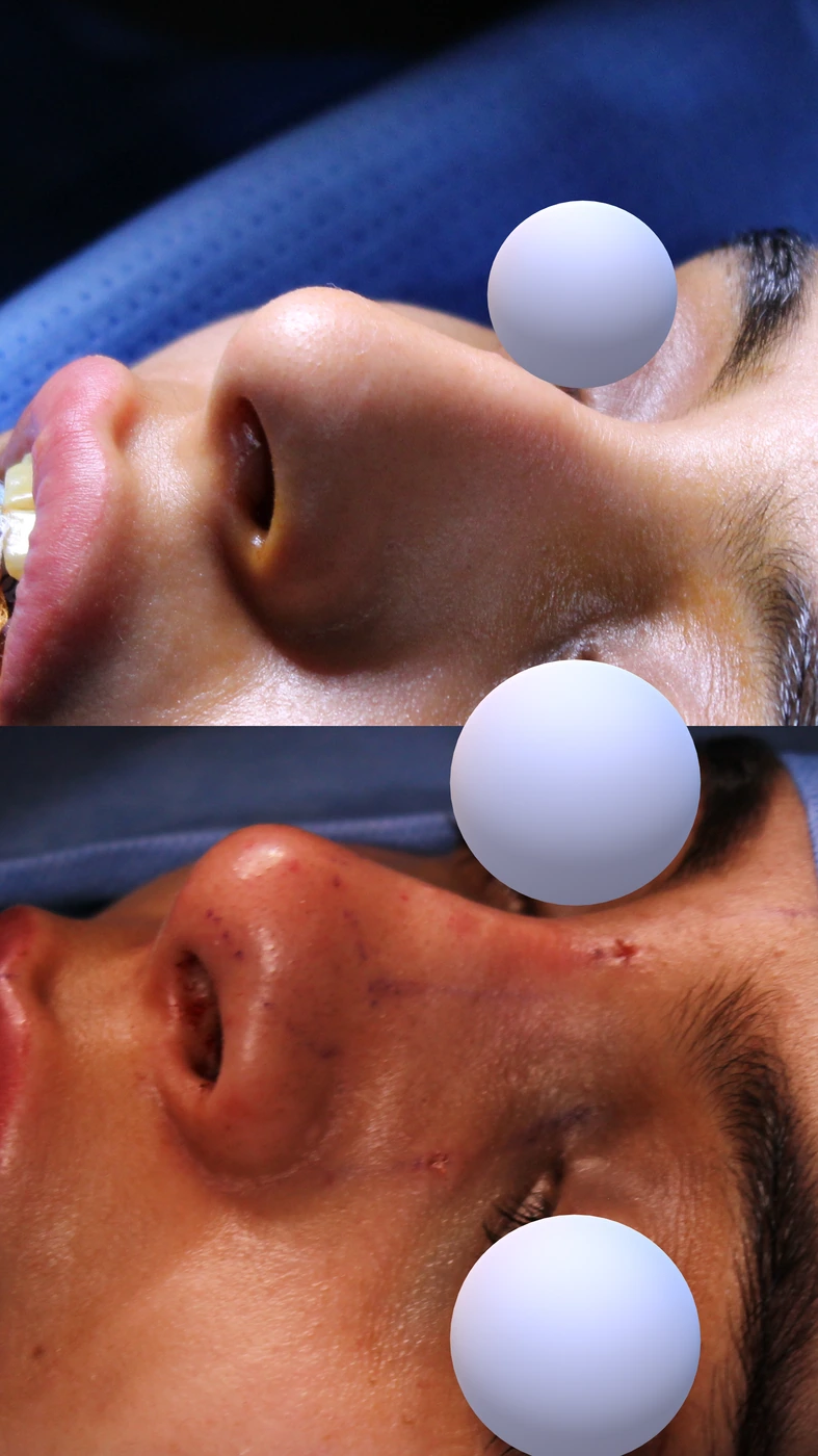 Closed preservation rhinoplasty — Left oblique
