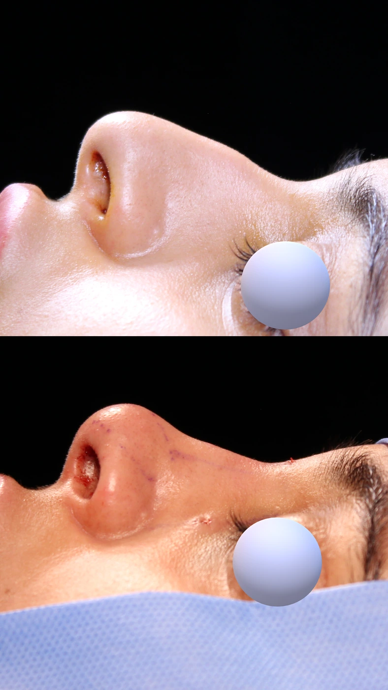 Closed preservation rhinoplasty — Left profile