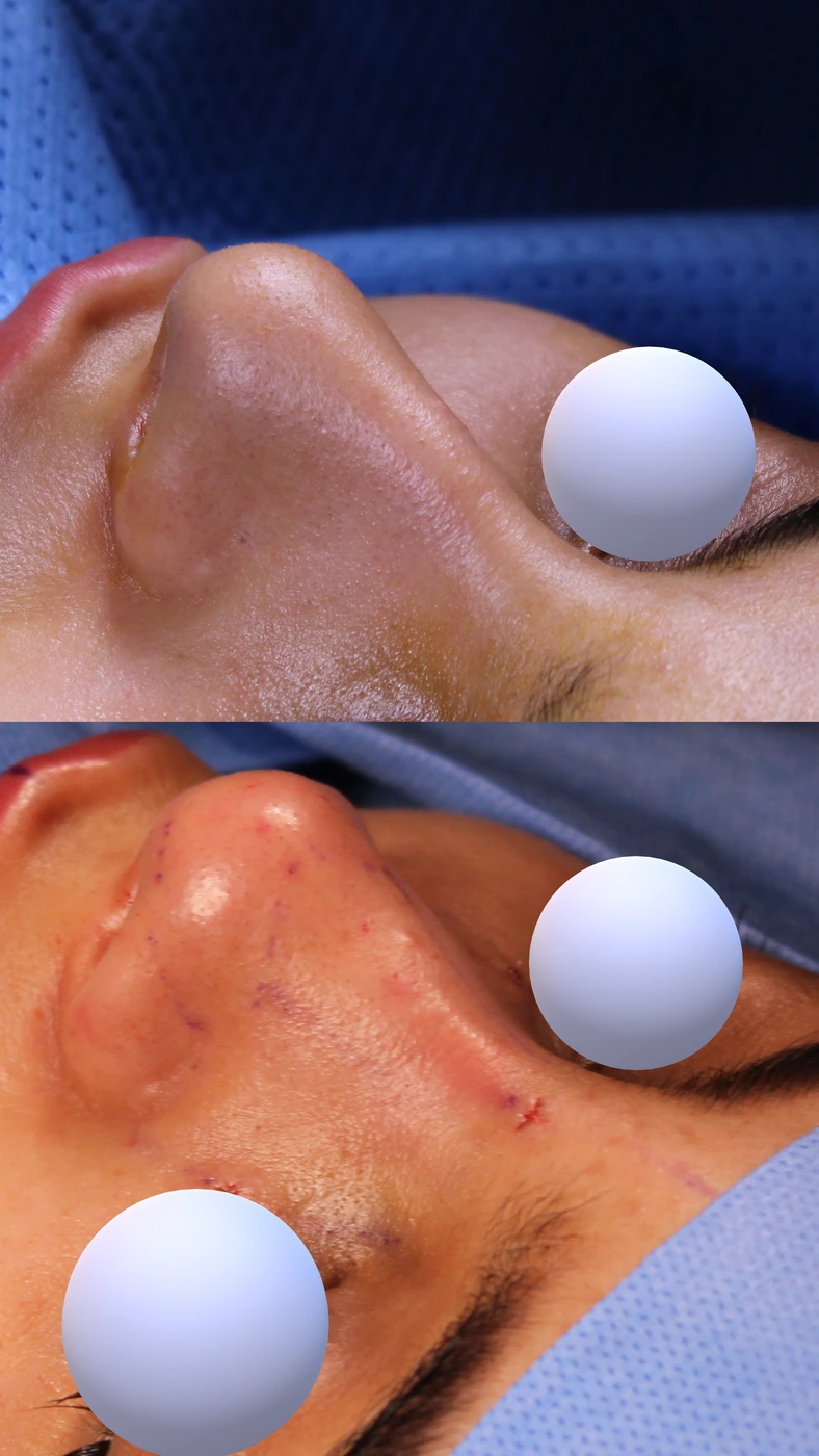 Closed preservation rhinoplasty — Left upper oblique