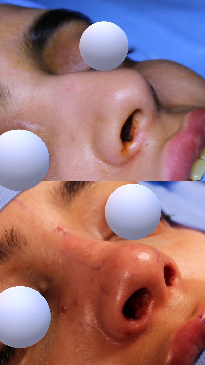 Closed preservation rhinoplasty — Right lower oblique