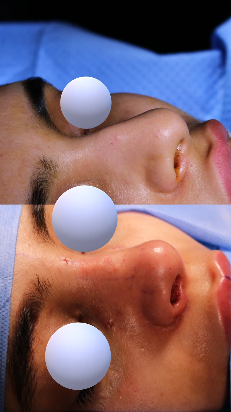 Closed preservation rhinoplasty — Right oblique