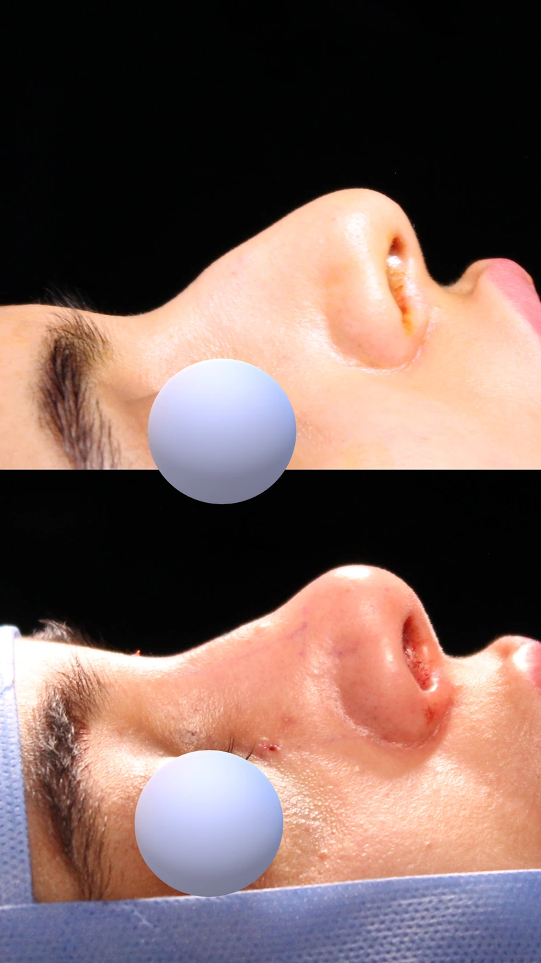 Closed preservation rhinoplasty — Right profile