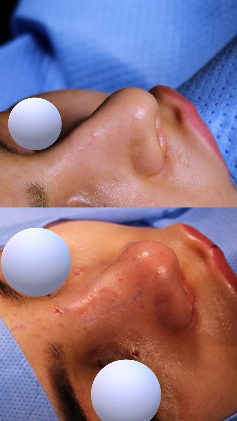 Closed preservation rhinoplasty — Right upper oblique