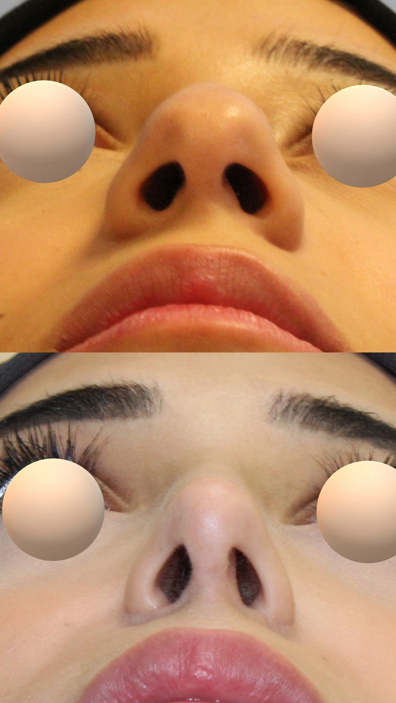 Rhinoplasty · case one — Basal view