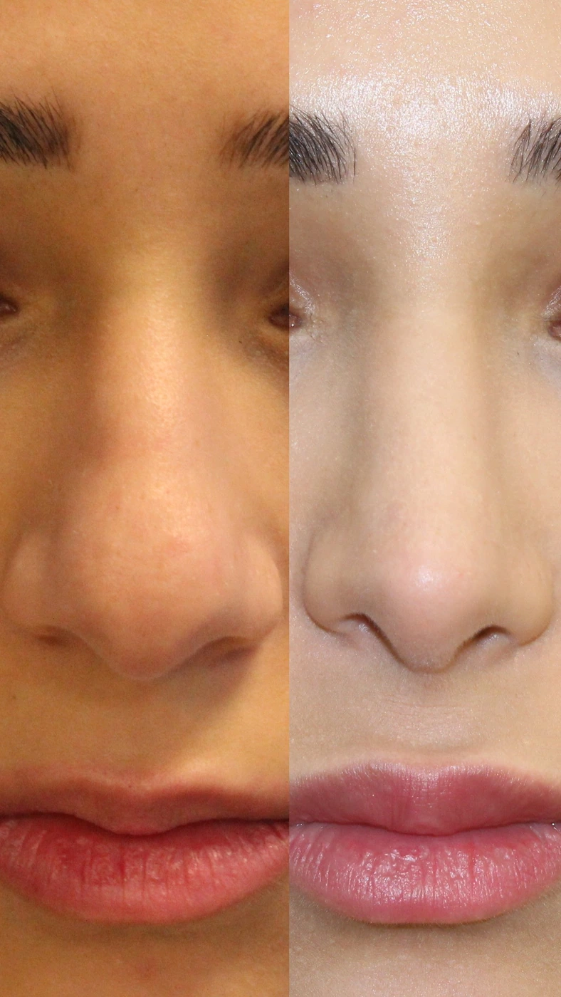 Rhinoplasty · case one — Front