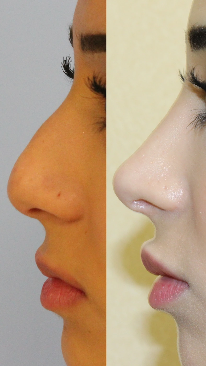 Rhinoplasty · case one — Left profile
