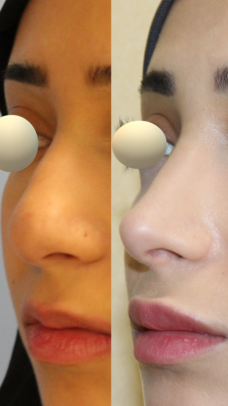 Rhinoplasty · case one — Left oblique