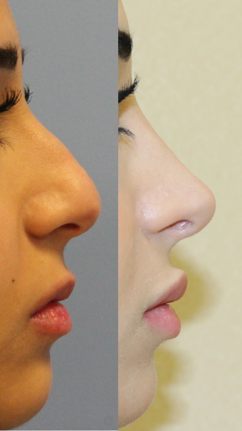 Rhinoplasty · case one — Right profile