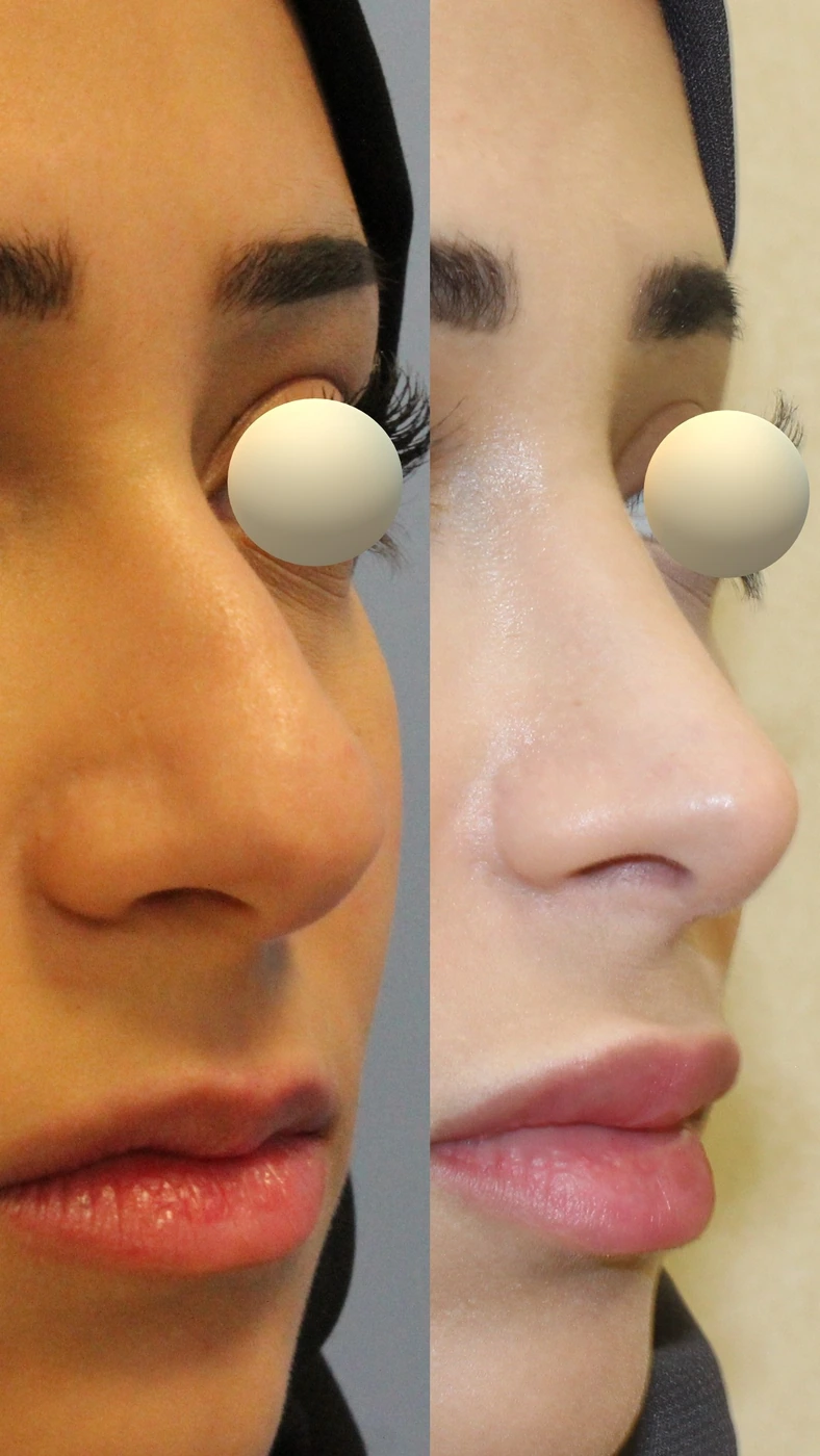 Rhinoplasty · case one — Right oblique