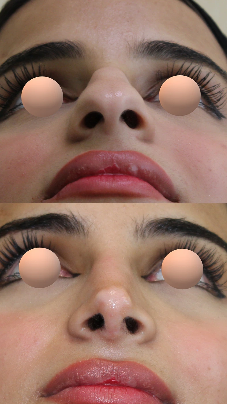 Rhinoplasty · case two — Basal view