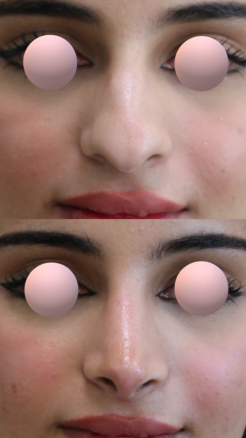 Rhinoplasty · case two — Front