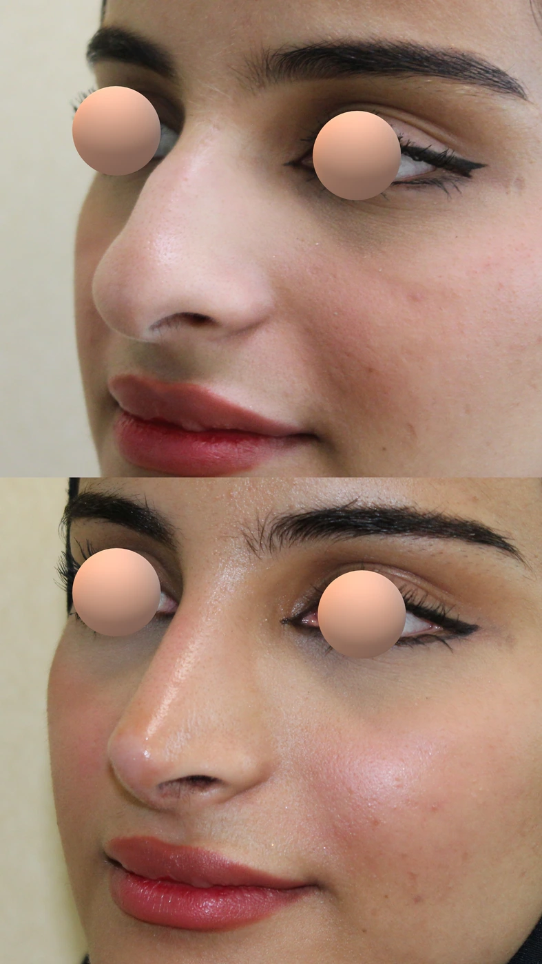 Rhinoplasty · case two — Left oblique