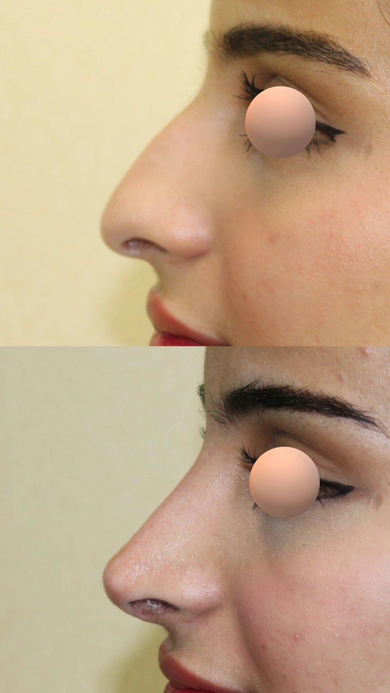 Rhinoplasty · case two — Left profile