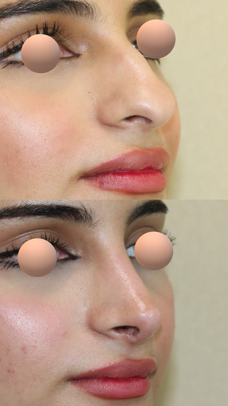 Rhinoplasty · case two — Right oblique