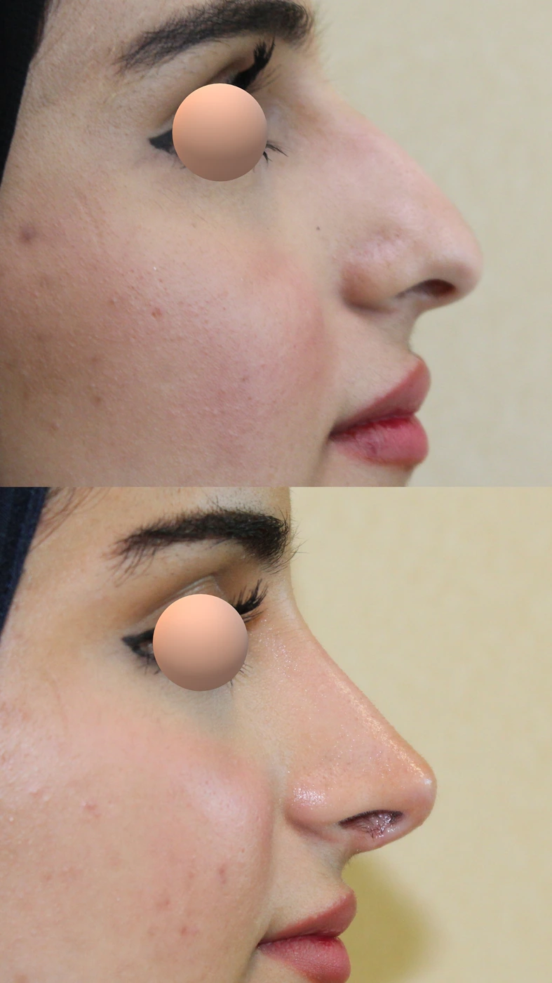 Rhinoplasty · case two — Right profile