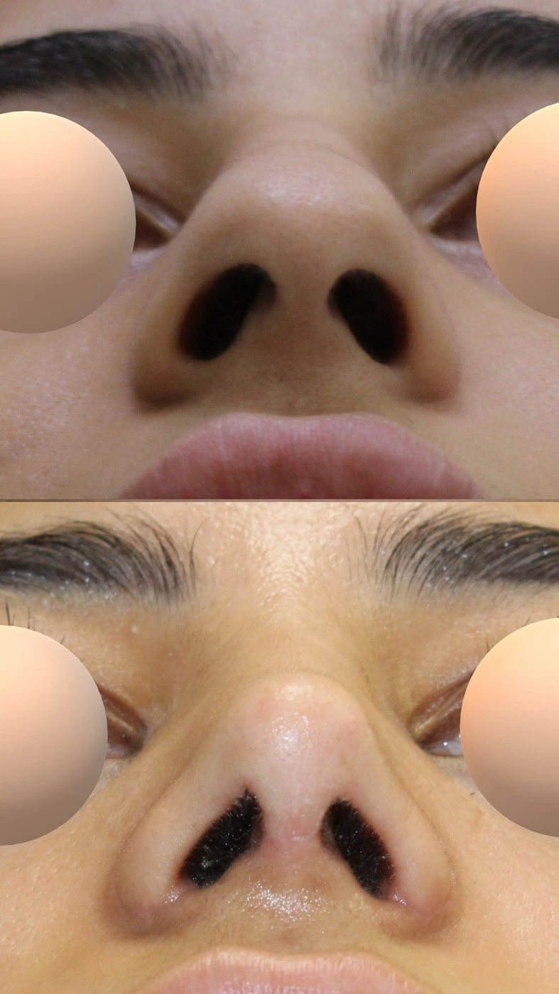 Rhinoplasty · case three — Basal view