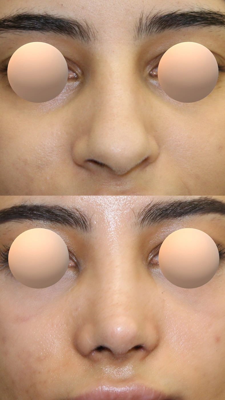 Rhinoplasty · case three — Front