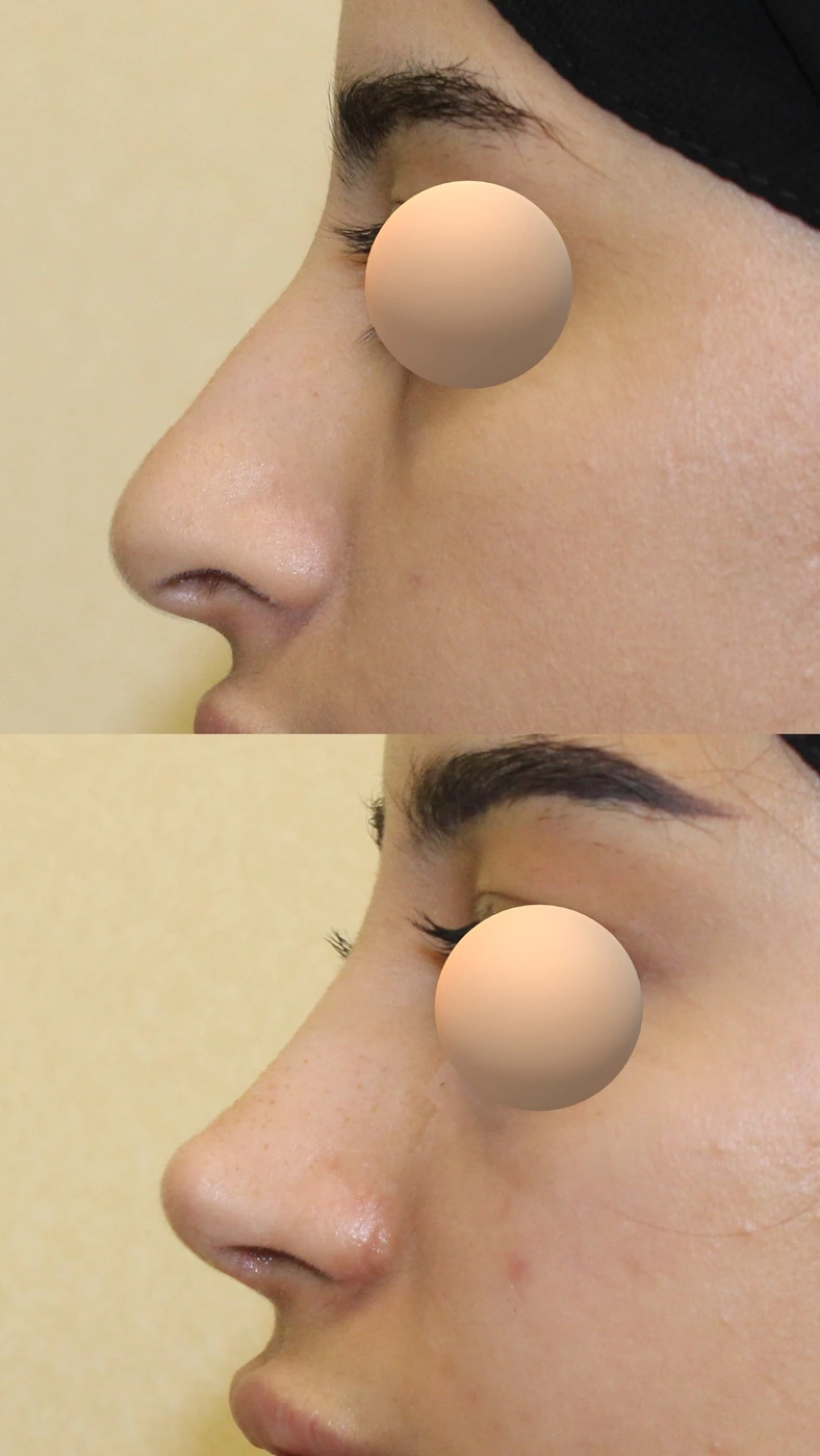 Rhinoplasty · case three — Left profile