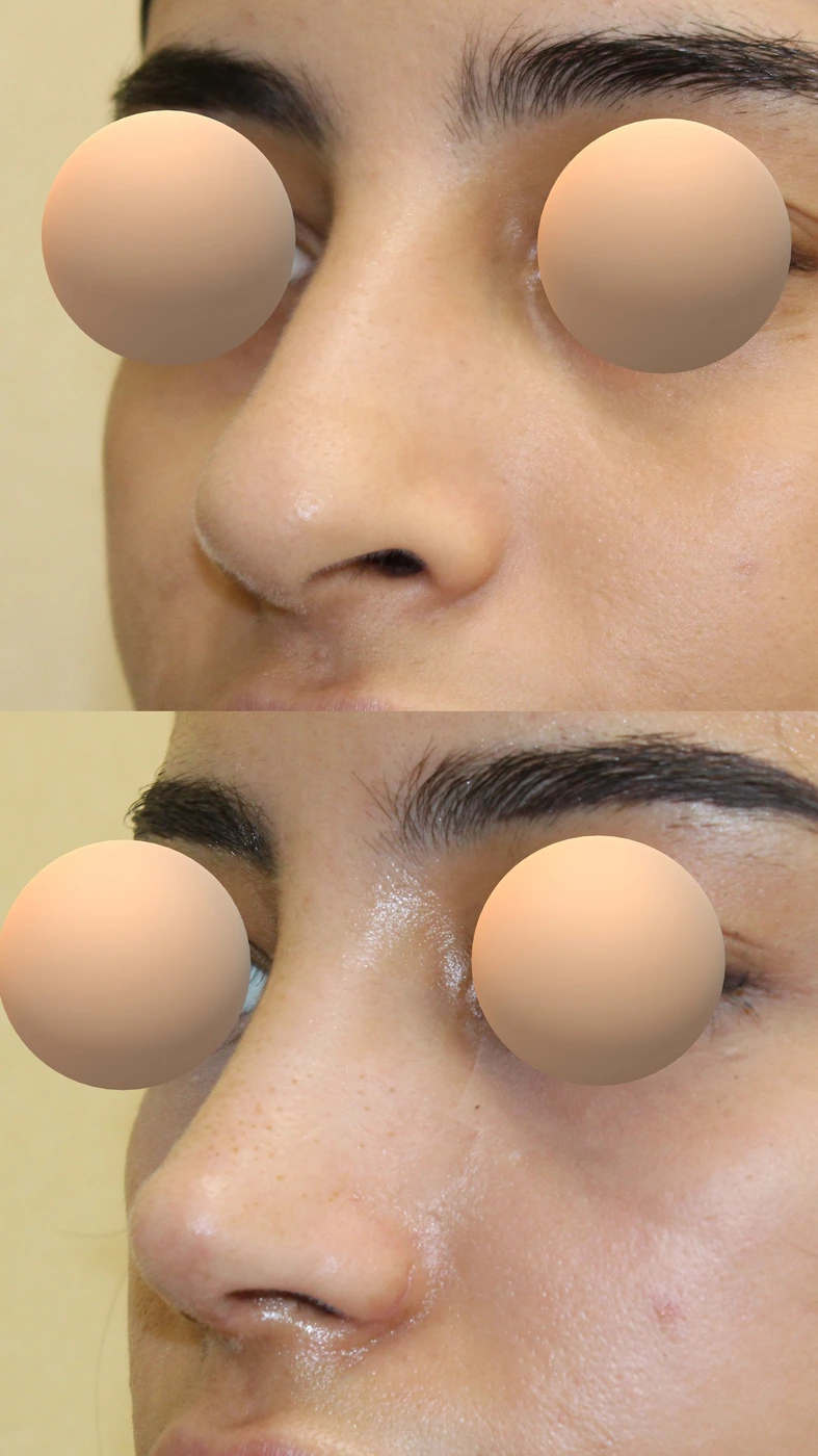 Rhinoplasty · case three — Left oblique