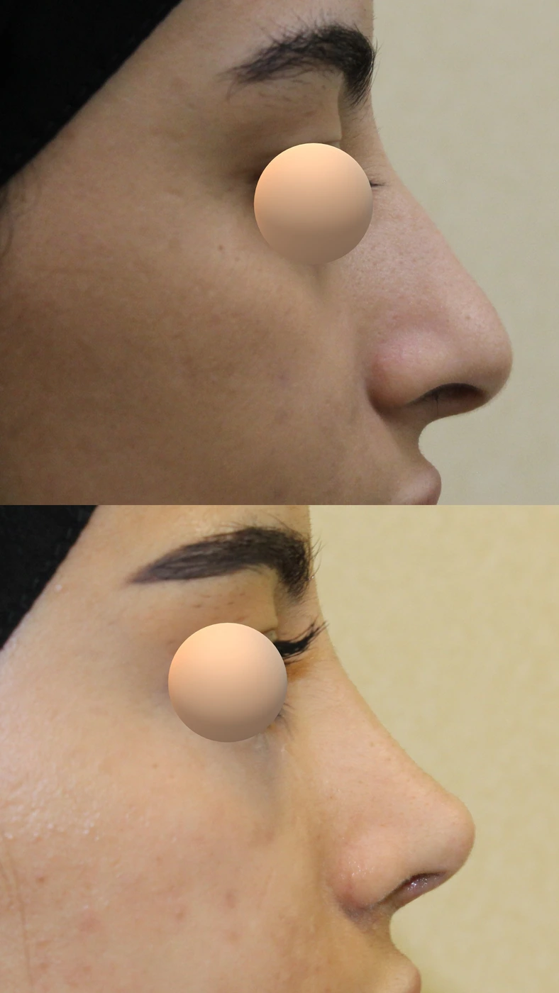 Rhinoplasty · case three — Right profile